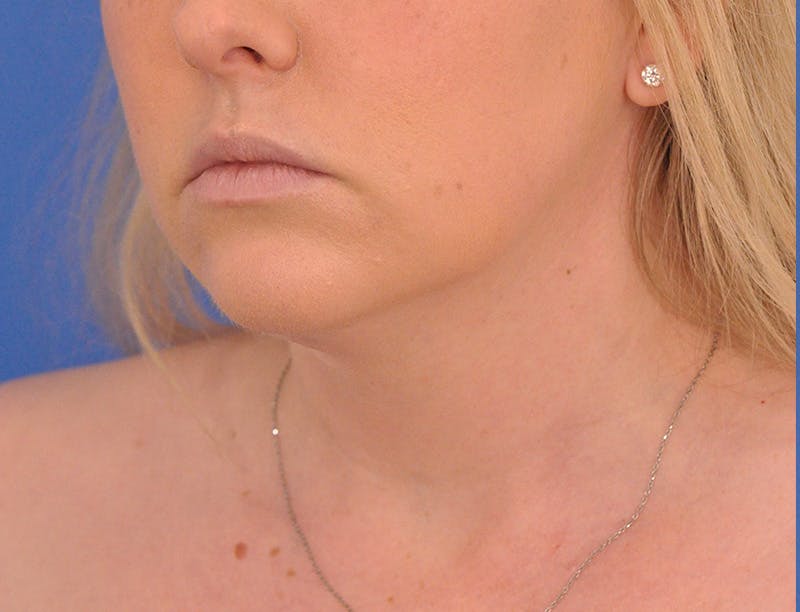 Neck Lift Before & After Gallery - Patient 144204 - Image 7