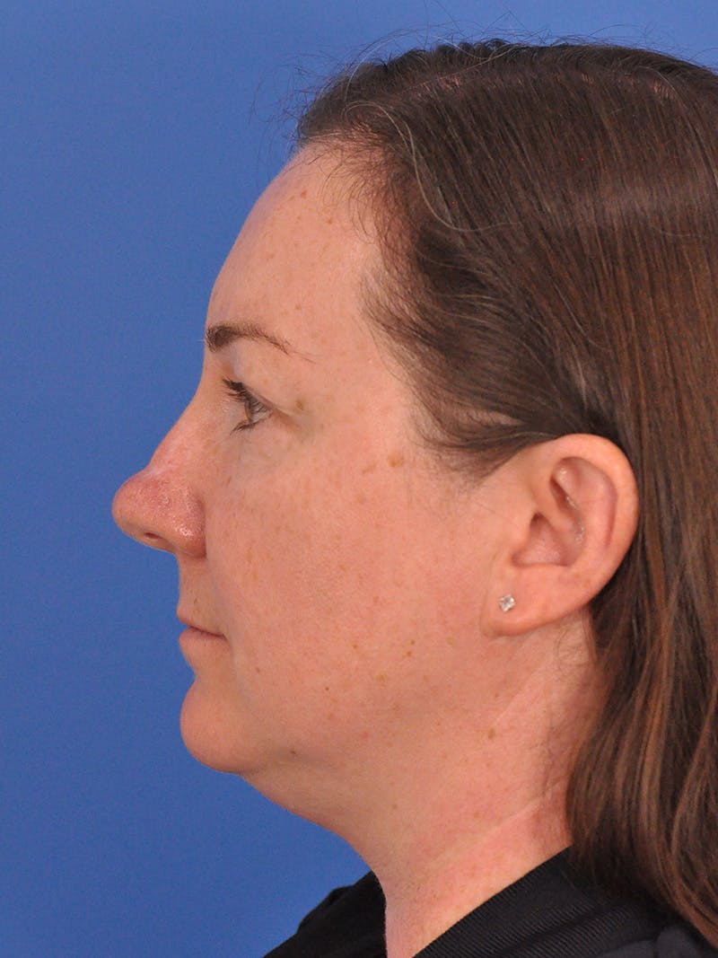 CO2RE Laser Before & After Gallery - Patient 350454 - Image 9