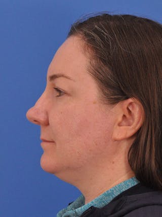 CO2RE Laser Before & After Gallery - Patient 350454 - Image 10