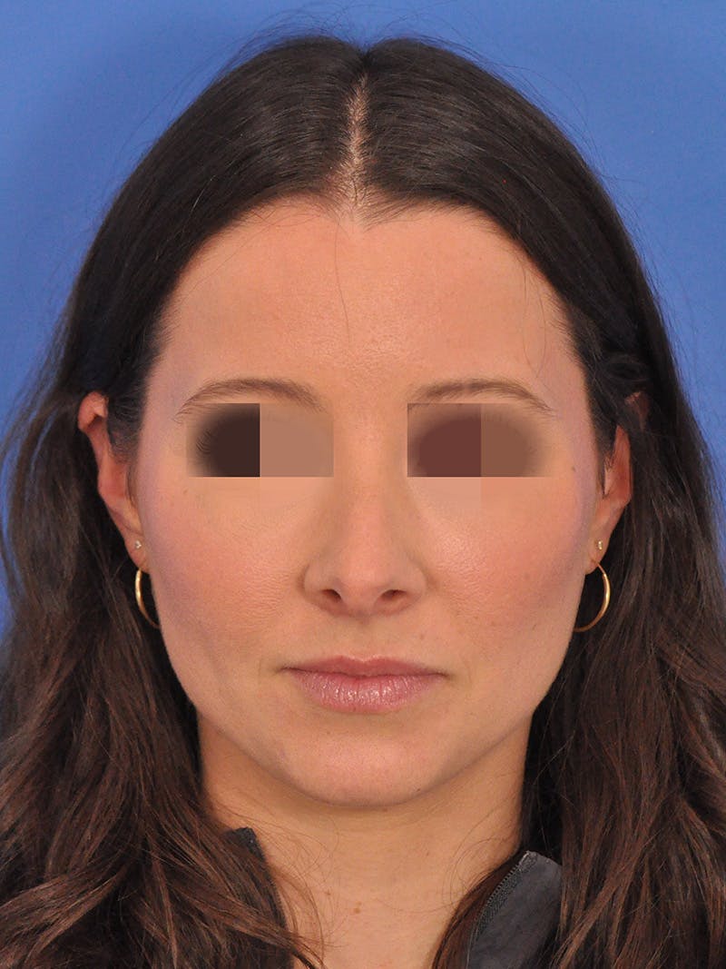 Rhinoplasty Before & After Gallery - Patient 358944 - Image 5