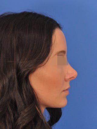 Rhinoplasty Before & After Gallery - Patient 358944 - Image 2