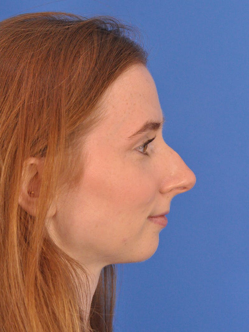 Rhinoplasty Before & After Gallery - Patient 307917 - Image 2