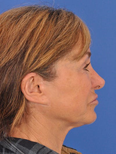 Neck Lift Before & After Gallery - Patient 388526 - Image 1