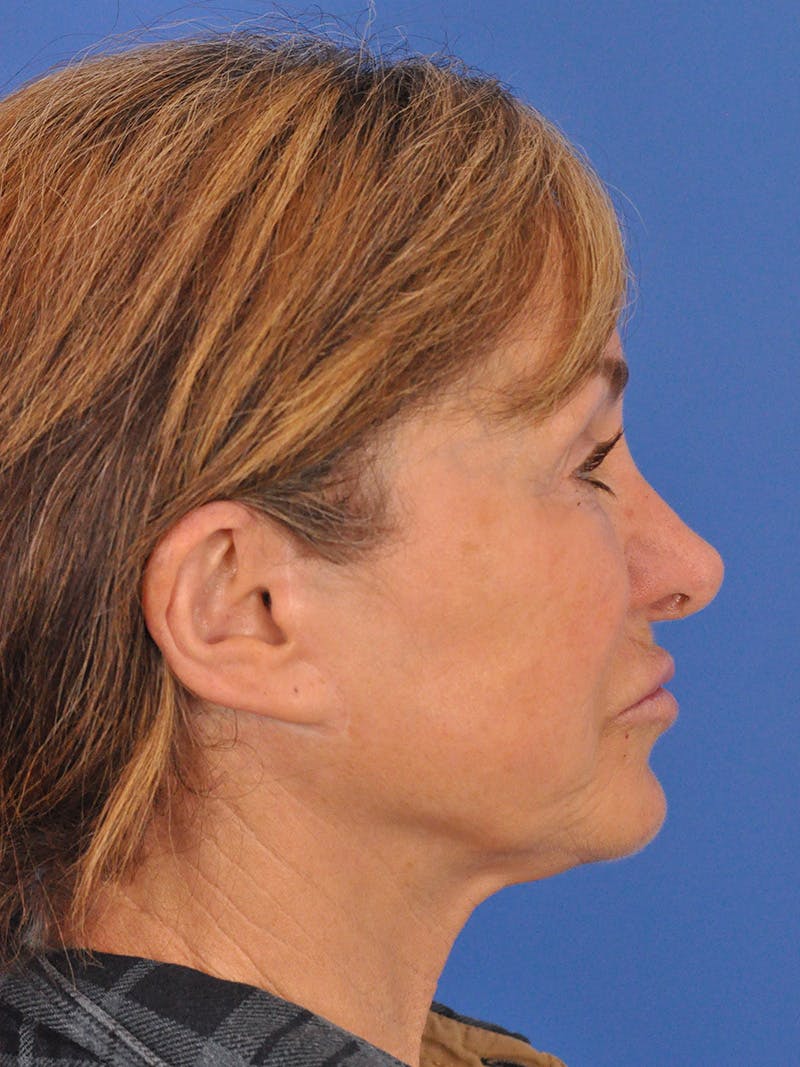 Lip Lift Before & After Gallery - Patient 261956 - Image 5