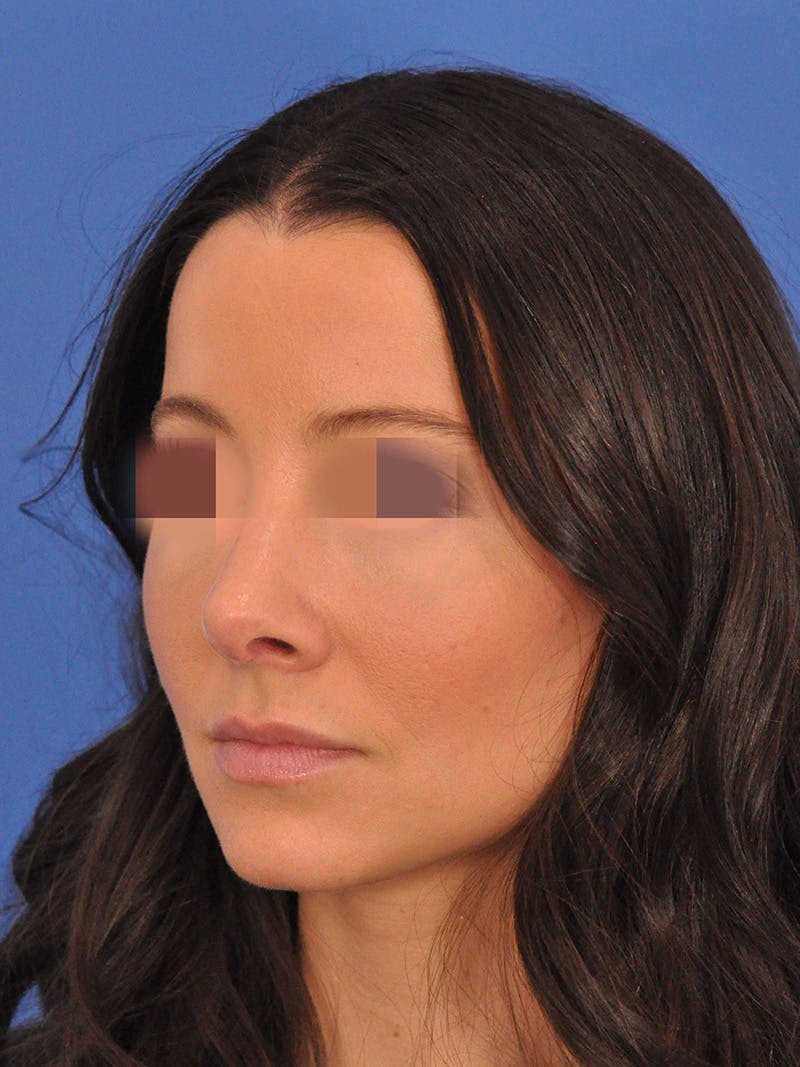 Rhinoplasty Before & After Gallery - Patient 358944 - Image 4