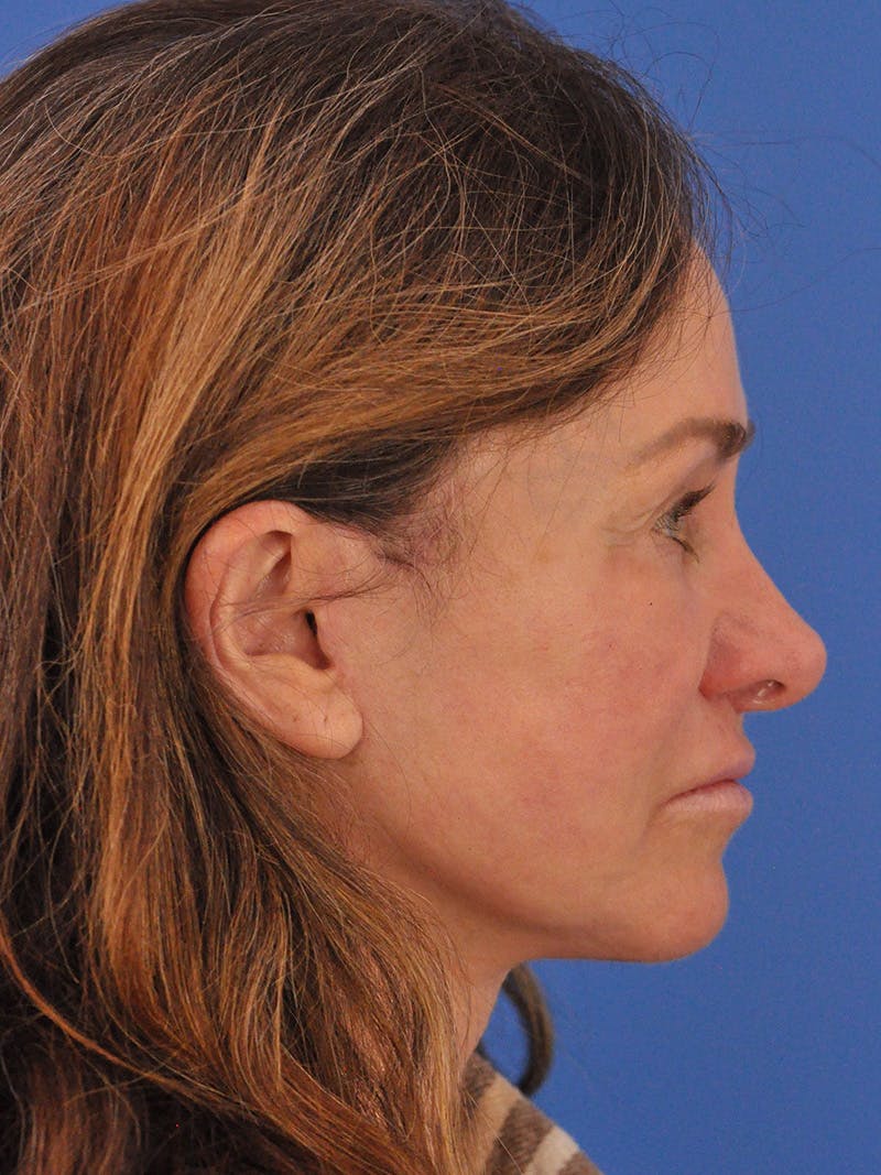 Lip Lift Before & After Gallery - Patient 261956 - Image 6