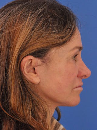 Neck Lift Before & After Gallery - Patient 388526 - Image 2