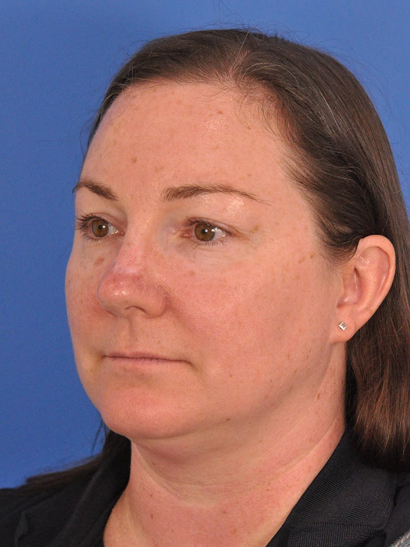 CO2RE Laser Before & After Gallery - Patient 350454 - Image 7
