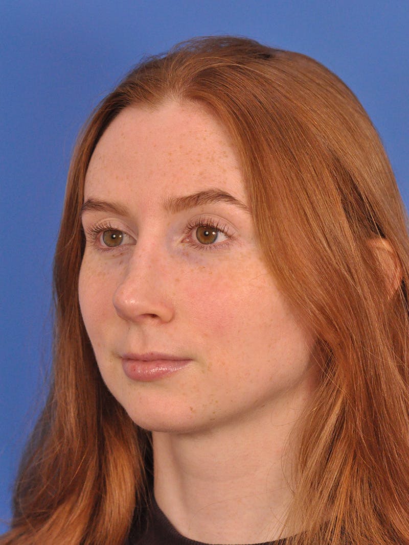 Rhinoplasty Before & After Gallery - Patient 307917 - Image 8