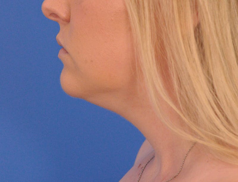 Neck Lift Before & After Gallery - Patient 144204 - Image 9