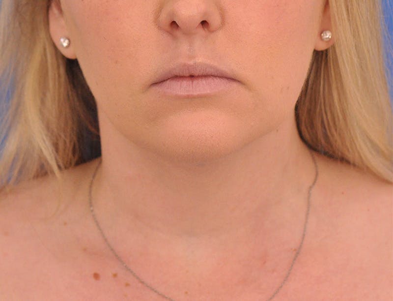 Neck Lift Before & After Gallery - Patient 144204 - Image 5