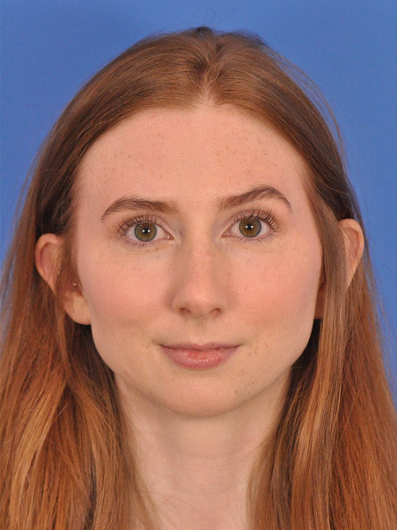 Rhinoplasty Before & After Gallery - Patient 307917 - Image 5