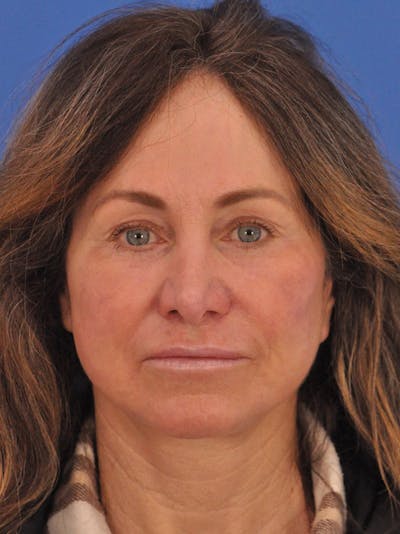 Lip Lift Before & After Gallery - Patient 261956 - Image 2
