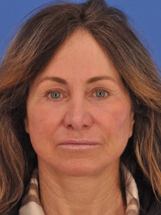 Neck Lift Before & After Gallery - Patient 388526 - Image 6