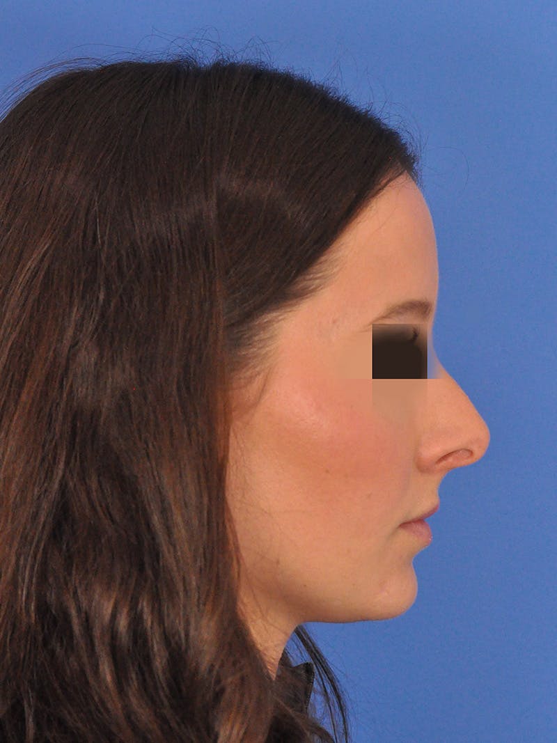Rhinoplasty Before & After Gallery - Patient 358944 - Image 1