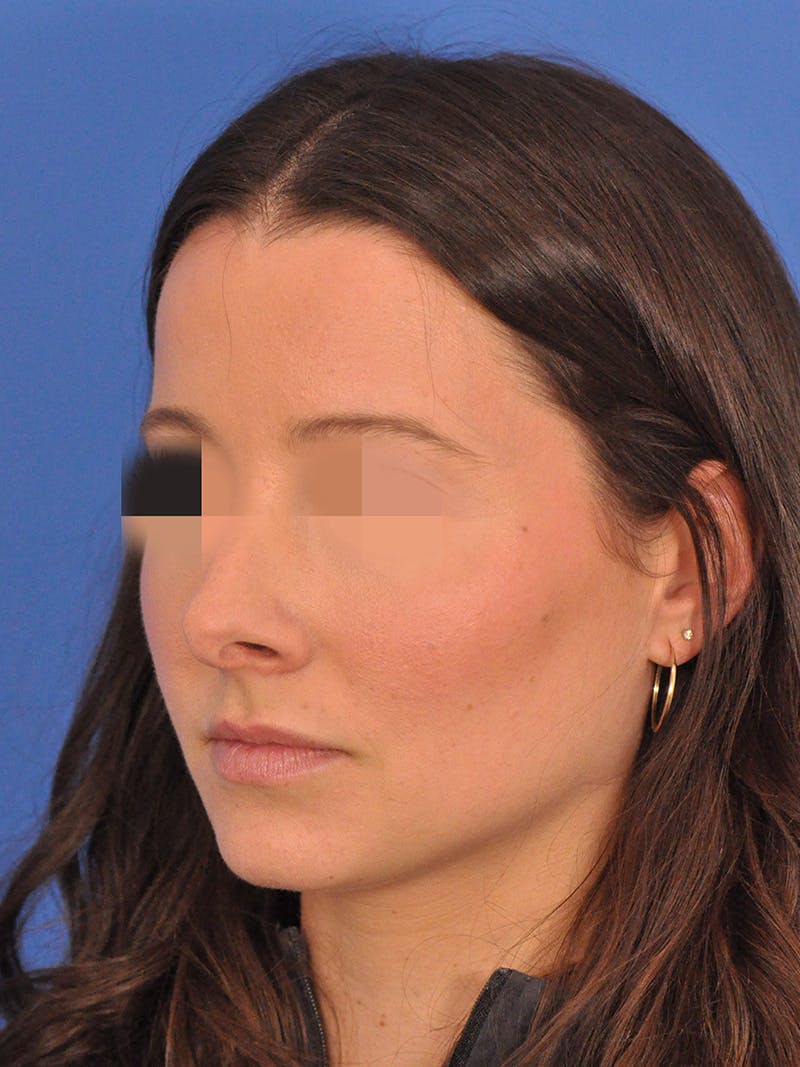 Rhinoplasty Before & After Gallery - Patient 358944 - Image 3