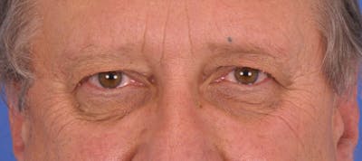 Blepharoplasty Before & After Gallery - Patient 355493 - Image 1