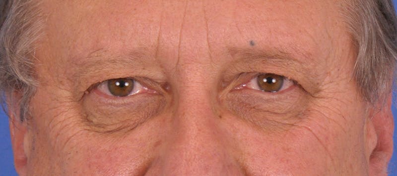 Blepharoplasty Before & After Gallery - Patient 355493 - Image 1