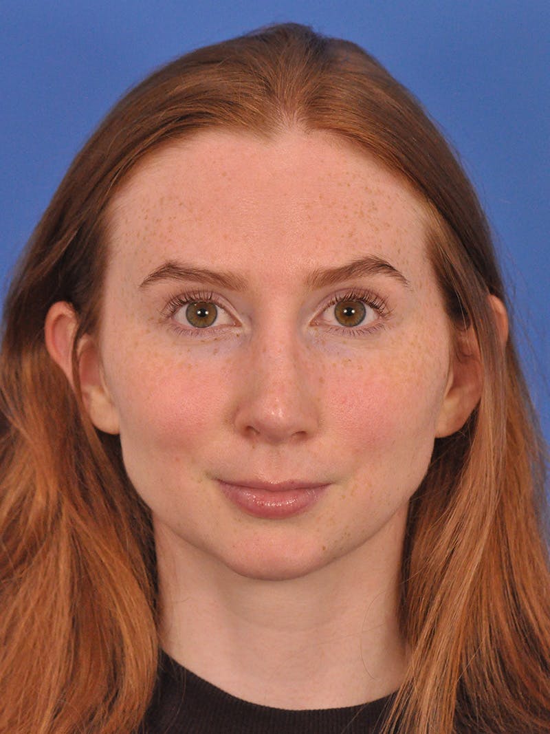 Rhinoplasty Before & After Gallery - Patient 307917 - Image 6