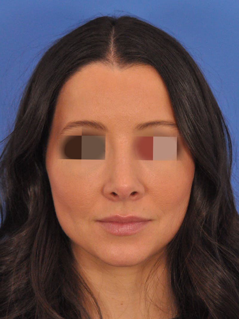 Rhinoplasty Before & After Gallery - Patient 358944 - Image 6