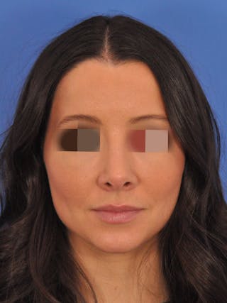 Rhinoplasty Before & After Gallery - Patient 358944 - Image 6
