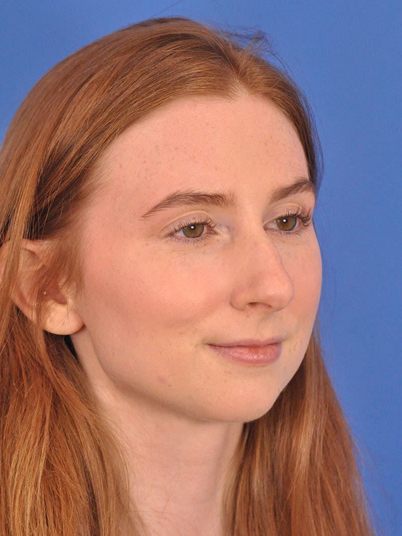 Rhinoplasty Before & After Gallery - Patient 307917 - Image 3