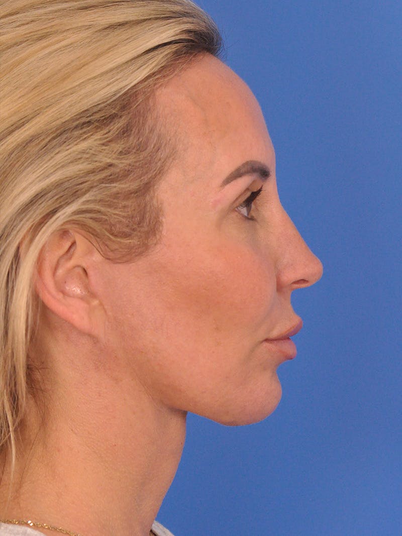 Facelift Before & After Gallery - Patient 401988 - Image 6