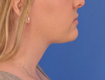 Neck Lift Before & After Gallery - Patient 144204 - Image 2