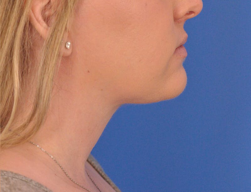 Neck Lift Before & After Gallery - Patient 144204 - Image 2