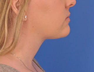 Neck Lift Before & After Gallery - Patient 144204 - Image 2
