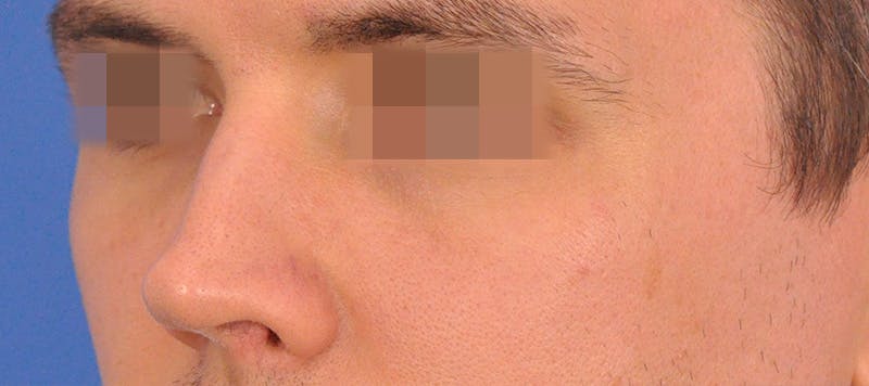 Rhinoplasty Before & After Gallery - Patient 373430 - Image 7