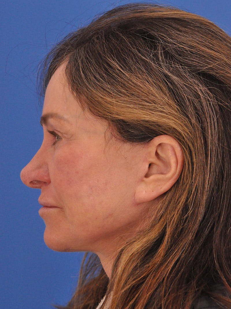 Lip Lift Before & After Gallery - Patient 261956 - Image 10