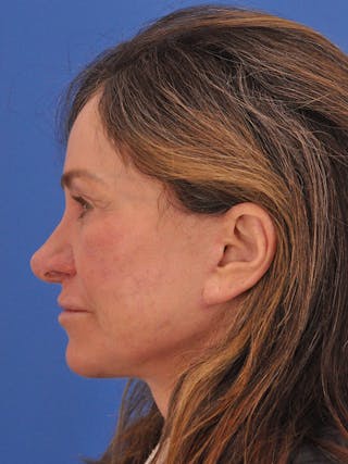 Neck Lift Before & After Gallery - Patient 388526 - Image 10