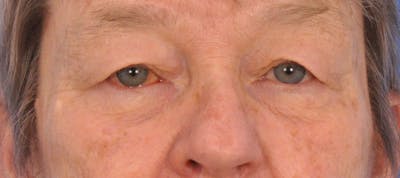Blepharoplasty Before & After Gallery - Patient 874712 - Image 1