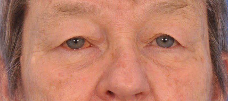 Blepharoplasty Before & After Gallery - Patient 874712 - Image 1
