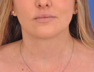 Neck Lift Before & After Gallery - Patient 144204 - Image 6