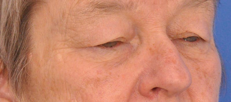 Blepharoplasty Before & After Gallery - Patient 874712 - Image 3