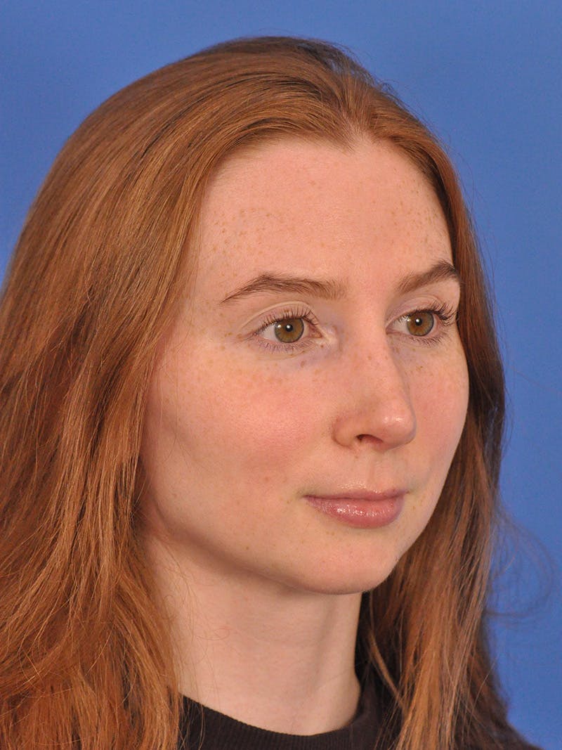 Rhinoplasty Before & After Gallery - Patient 307917 - Image 4