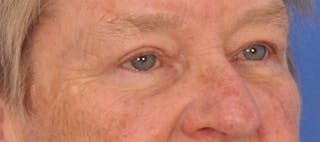 Blepharoplasty Before & After Gallery - Patient 874712 - Image 4