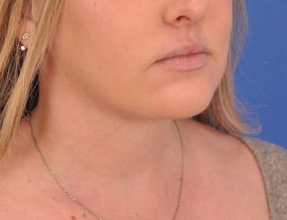 Neck Lift Before & After Gallery - Patient 144204 - Image 4