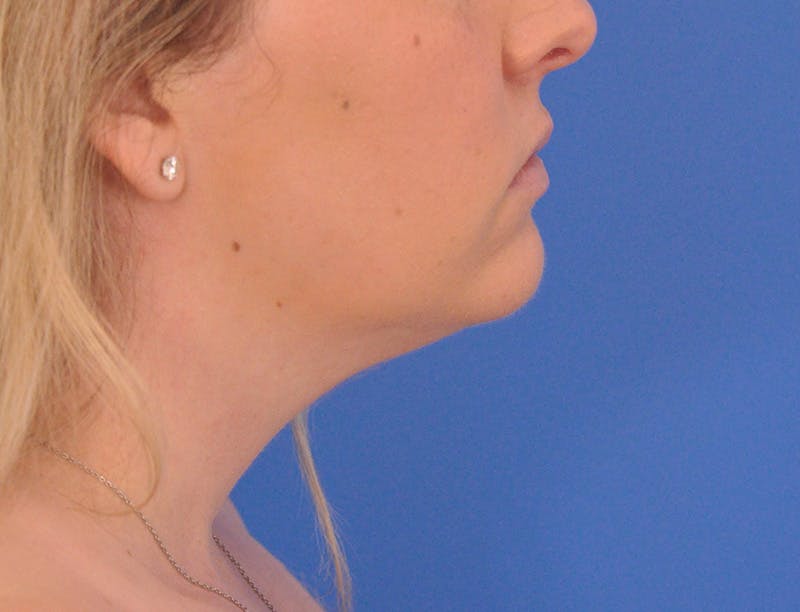 Neck Lift Before & After Gallery - Patient 144204 - Image 1