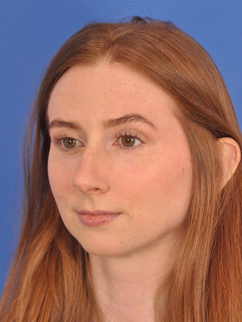 Rhinoplasty Before & After Gallery - Patient 307917 - Image 7