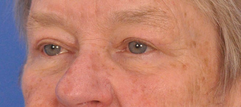 Blepharoplasty Before & After Gallery - Patient 874712 - Image 8
