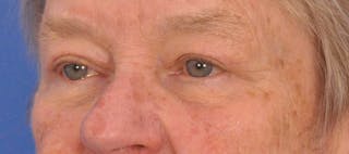 Blepharoplasty Before & After Gallery - Patient 874712 - Image 8