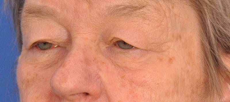 Blepharoplasty Before & After Gallery - Patient 874712 - Image 7