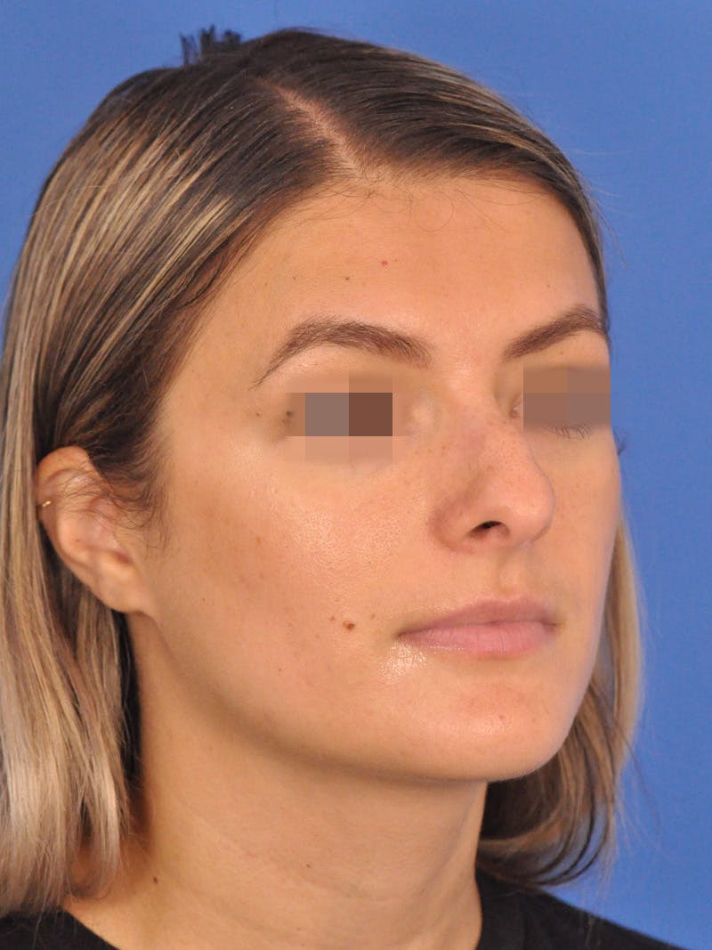 Rhinoplasty Before & After Gallery - Patient 716844 - Image 3