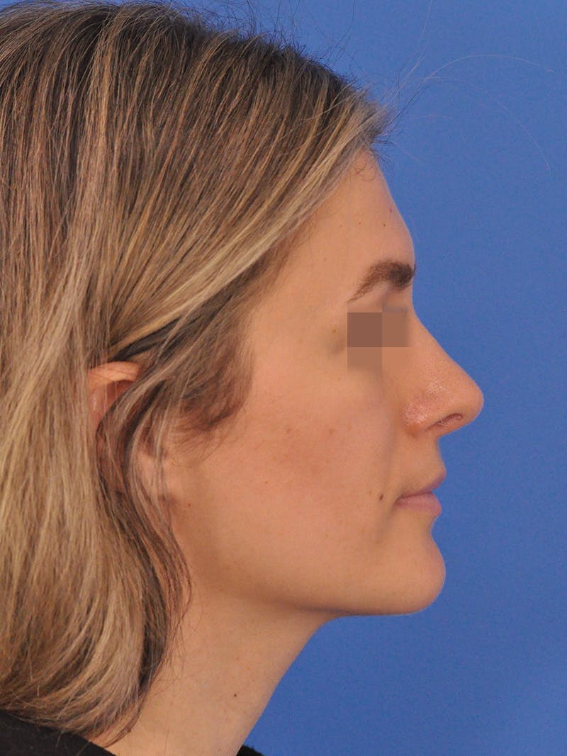 Rhinoplasty Before & After Gallery - Patient 716844 - Image 2