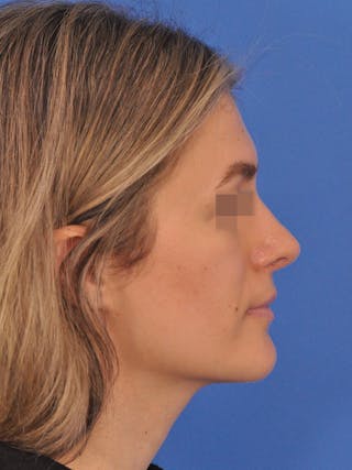 Rhinoplasty Before & After Gallery - Patient 716844 - Image 2