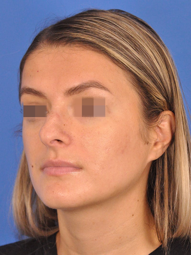 Rhinoplasty Before & After Gallery - Patient 716844 - Image 7