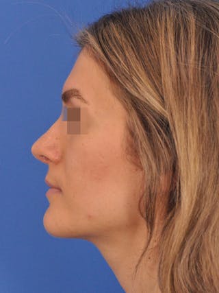 Rhinoplasty Before & After Gallery - Patient 716844 - Image 10